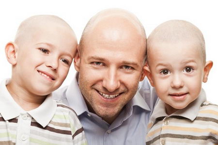 андрогенетическая алопеция