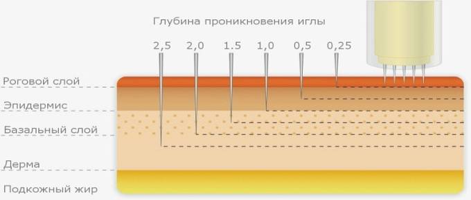 микронидлинг винница
