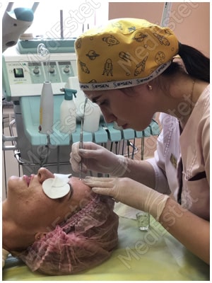 чистка кожи лица в виннице