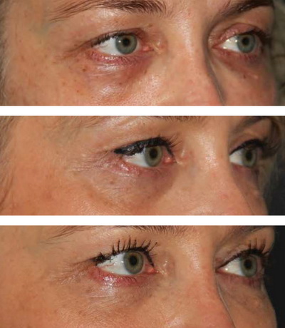 эффект тиндалла