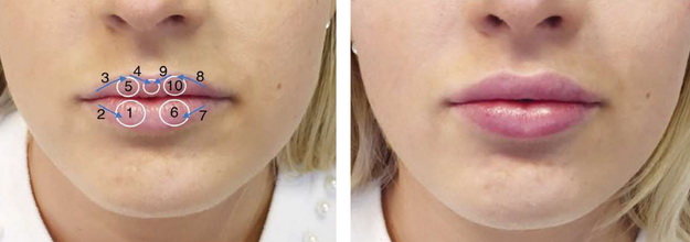 Техника Nonsurgical Lip Lift 