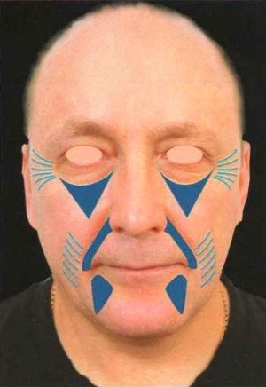 ris-1-biorevolumetria