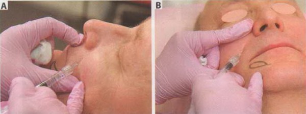 коррекция дефицита объема области носогубной складки