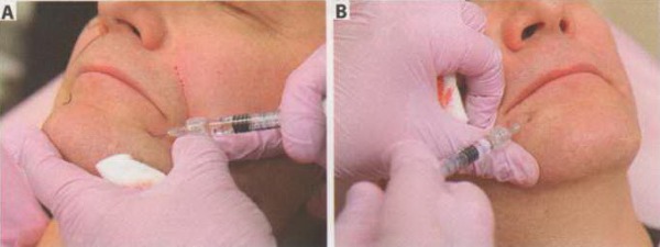 коррекция губокраевой борозды и подбородка 