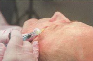 коррекция мимических морщин периорбитальной области