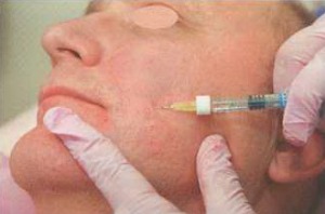 внутрикожное армирова¬ние морщин средней и нижней трети лица