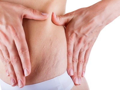 удаление растяжек в виннице