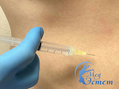 Убрать жир с помощью уколов в виннице