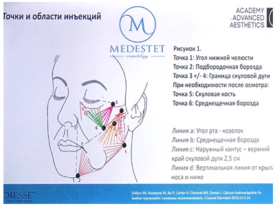 когда применять Radiesse