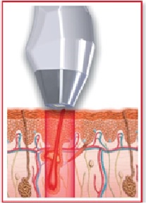 Эпиляция диодным лазером
