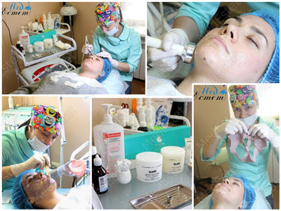 лазерная шлифовка лица в МедЭстет Винница