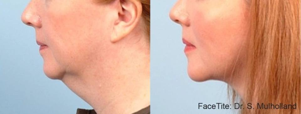 rf lifting vinnytsia